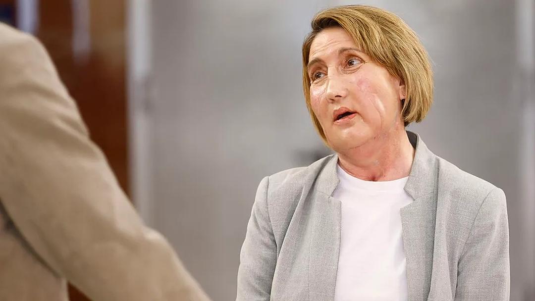 Woman Receives First Face Transplant from Euthanized Donor