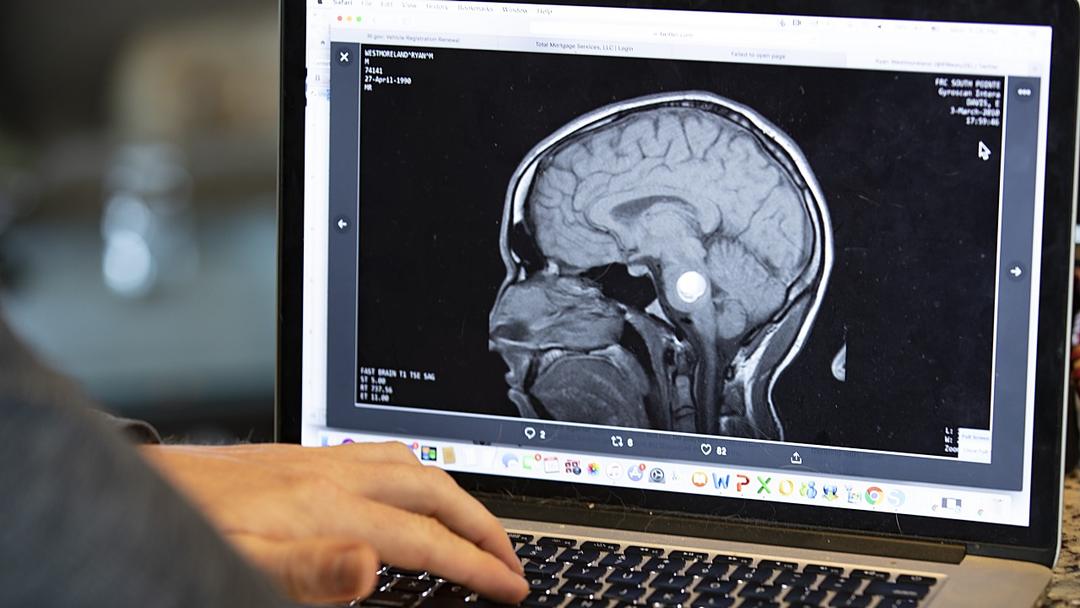 Alzheimer's Drugs Show 'Trivial' Benefits, Review Finds