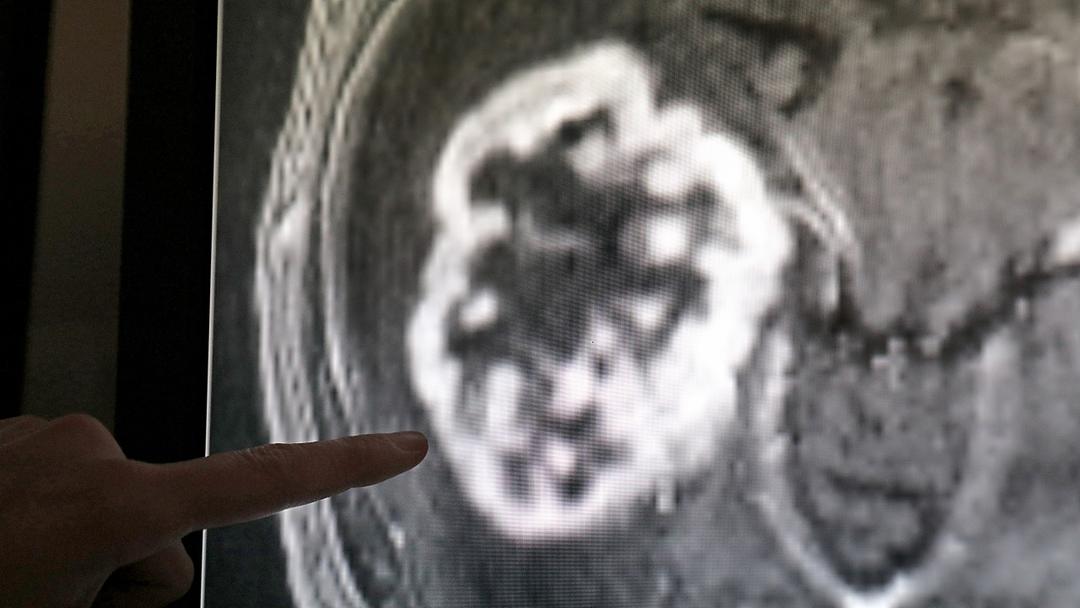 Study: Cancer Jab Eliminates Tumors in Patients