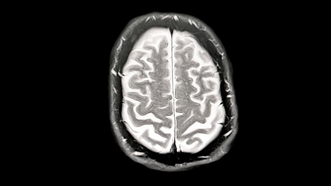 Study: Chronic Financial Worries May Accelerate Brain Aging